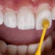 Dental Veneers: Cost, Procedure, and Results