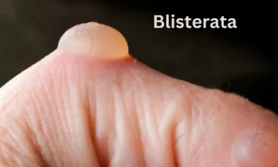 Blisterata: The Ultimate Guide to Understanding and Managing